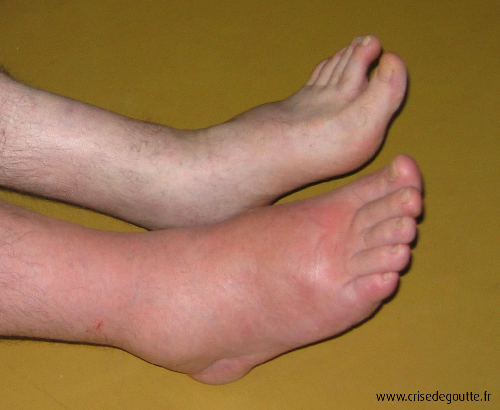 Cheville inflammation Cheville inflammation